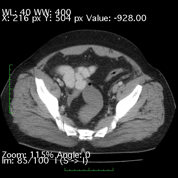 Acute pancreatitis (Radiopaedia 34043-35276 Axial C+ portal venous phase 85).jpg