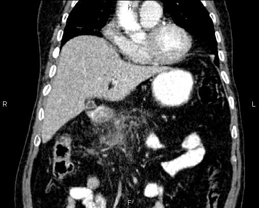 Acute pancreatitis (Radiopaedia 85146-100701 Coronal C+ portal venous phase 25).jpg