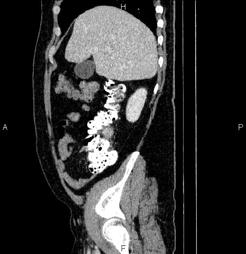 Acute pancreatitis (Radiopaedia 85390-101010 Sagittal C+ portal venous phase 19).jpg