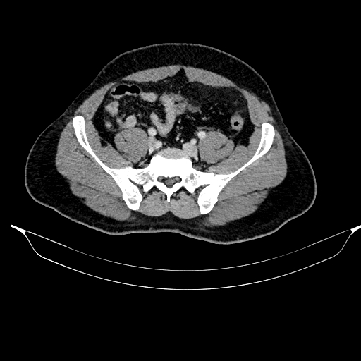 Acute pancreatitis (Radiopaedia 87428-103757 Axial C+ portal venous phase 74).jpg