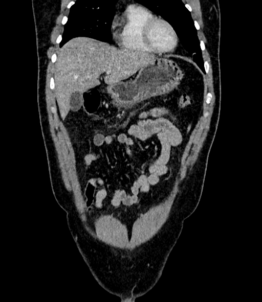 Acute pancreatitis (Radiopaedia 87428-103757 Coronal C+ portal venous phase 23).jpg