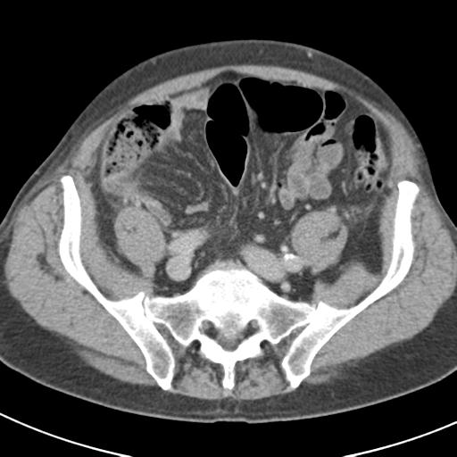 Acute pancreatitis and walled-off necrosis (Radiopaedia 29888-30403 Axial C+ delayed 63).jpg