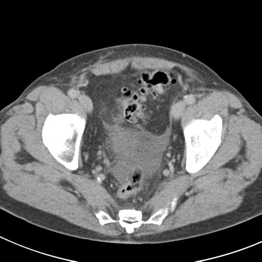 Acute pancreatitis and walled-off necrosis (Radiopaedia 29888-30403 Axial C+ delayed 74).jpg