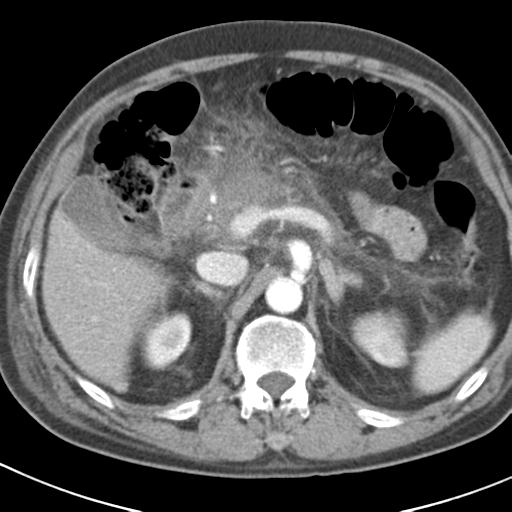 File:Acute pancreatitis and walled-off necrosis (Radiopaedia 29888-30403 Axial C+ portal venous phase 14).jpg