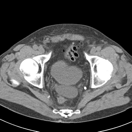 File:Acute pancreatitis and walled-off necrosis (Radiopaedia 29888-30403 Axial non-contrast 71).jpg