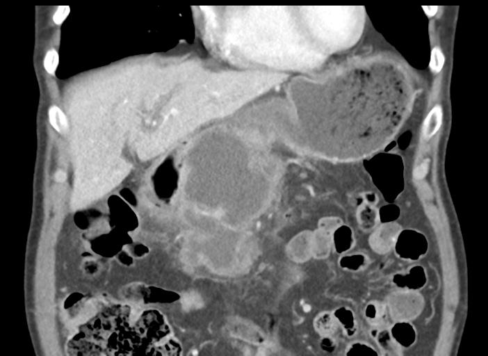 Acute pancreatitis and walled-off necrosis (Radiopaedia 29888-30404 Coronal C+ portal venous phase 17).jpg