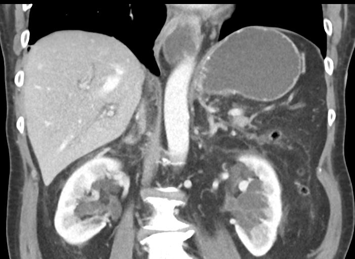 Acute pancreatitis and walled-off necrosis (Radiopaedia 29888-30404 Coronal C+ portal venous phase 32).jpg