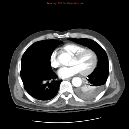 File:Acute pancreatitis with incidental pancreatic lipoma (Radiopaedia 10190-10730 Axial C+ arterial phase 4).jpg