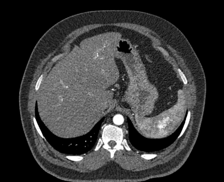 Acute pulmonary embolism with pulmonary infarcts (Radiopaedia 77688-89908 Axial C+ CTPA 65).jpg