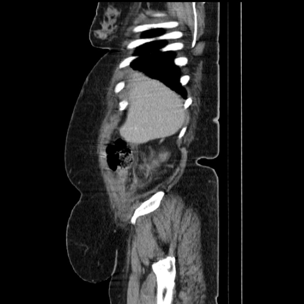 Acute pyelonephritis (Radiopaedia 25657-25837 Sagittal renal parenchymal phase 19).jpg