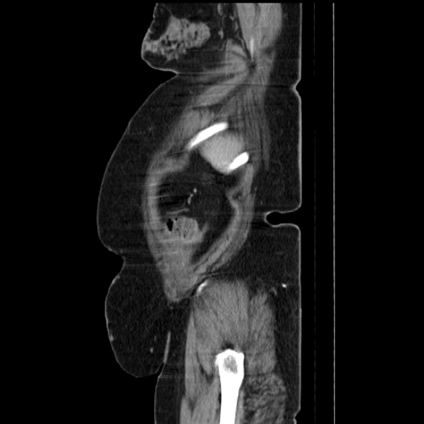 Acute pyelonephritis (Radiopaedia 25657-25837 Sagittal renal parenchymal phase 70).jpg