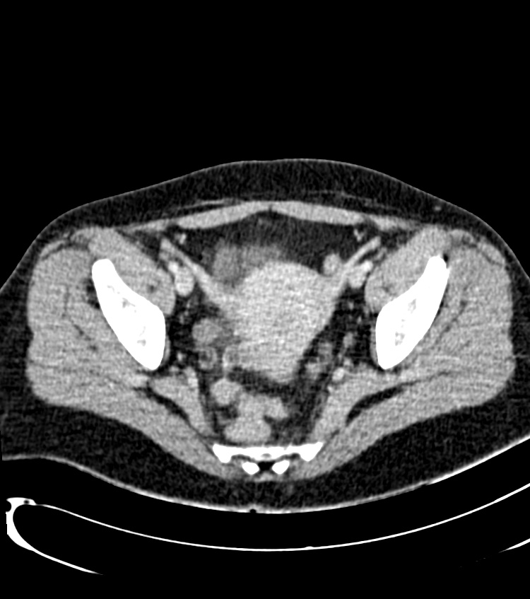 Acute pyelonephritis (Radiopaedia 40264-42816 Axial C+ portal venous phase 56).jpg