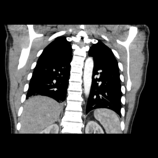 Acute segmental pulmonary emboli and pulmonary infarction (Radiopaedia 62264-70444 Coronal C+ CTPA 40).jpg