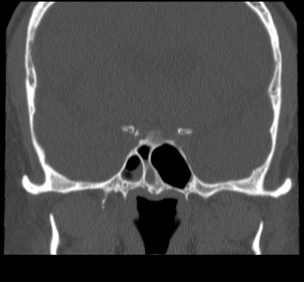 Acute sinusitis (Radiopaedia 23161-23215 Coronal bone window 51).jpg