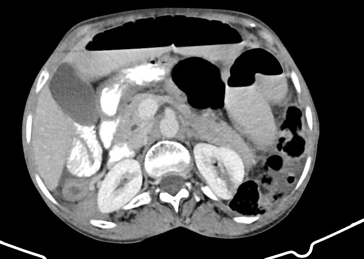 File:Acute small bowel (ileal) volvulus (Radiopaedia 71740-82139 Axial C+ portal venous phase 77).jpg