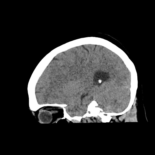 Acute subarachnoid hemorrhage and accessory anterior cerebral artery (Radiopaedia 69231-79008 Sagittal non-contrast 40).jpg