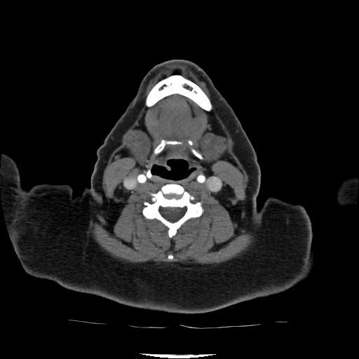 Acute subarachnoid hemorrhage and accessory anterior cerebral artery (Radiopaedia 69231-79009 Axial C+ arterial phase 48).jpg