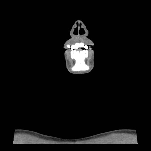 File:Acute submandibular sialadenitis secondary to ductal stone (Radiopaedia 27999-28267 Coronal C+ delayed 6).jpg