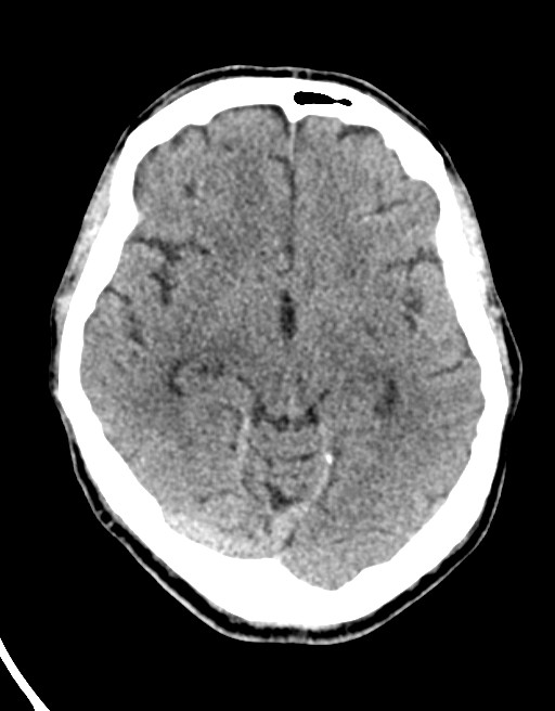 Acute superior cerebellar artery territory infarct (Radiopaedia 84104-99359 Axial non-contrast 41).jpg