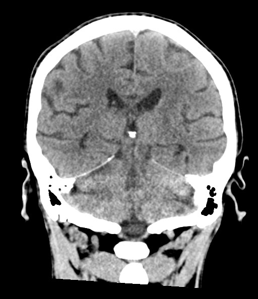 File:Acute superior cerebellar artery territory infarct (Radiopaedia 84104-99359 Coronal non-contrast 58).jpg