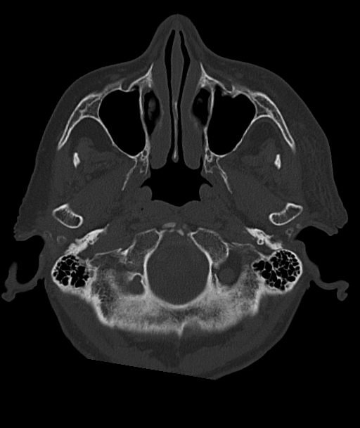 Acute traumatic subdural hematoma (Radiopaedia 82921-97257 Axial bone window 94).jpg