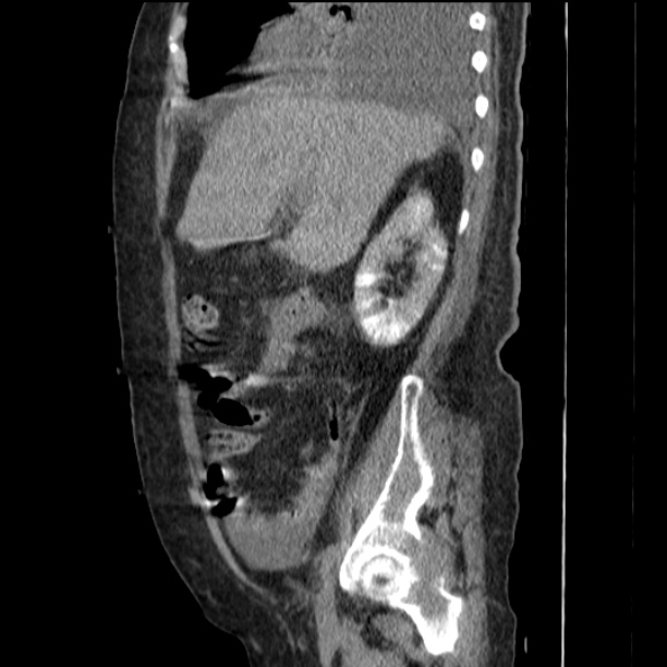 Acute tubular necrosis (Radiopaedia 28077-28334 Sagittal non-contrast 30).jpg