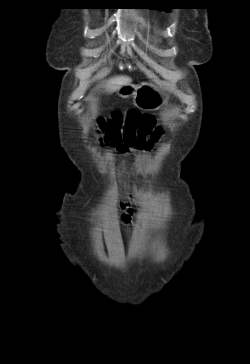 Adenocarcinoma of cecum (Radiopaedia 59222-66549 Coronal C+ portal venous phase 3).jpg