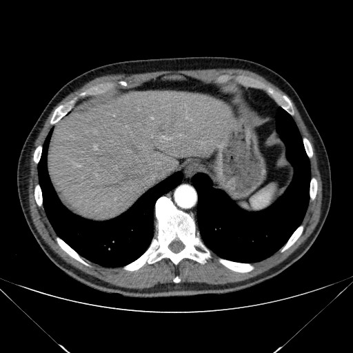 Adenocarcinoma of the lung (Radiopaedia 59871-67325 Axial C+ arterial phase 81).jpg
