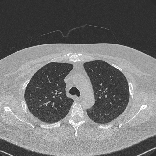 Adenoid cystic carcinoma of the trachea (Radiopaedia 49042-54137 Axial lung window 101).jpg
