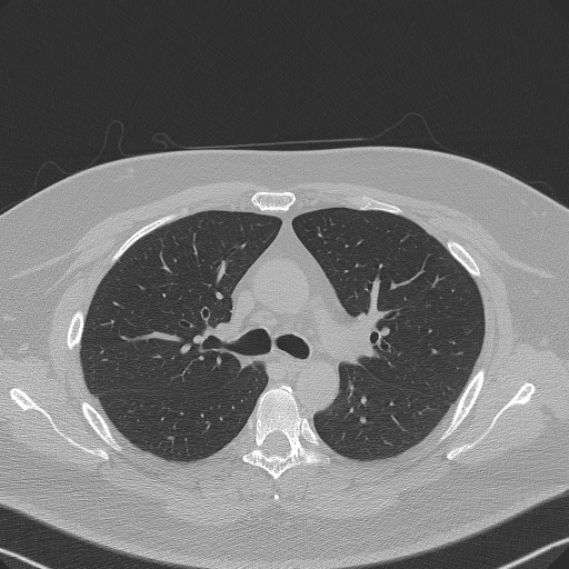 Adenoid cystic carcinoma of the trachea (Radiopaedia 49042-54137 Axial lung window 125).jpg
