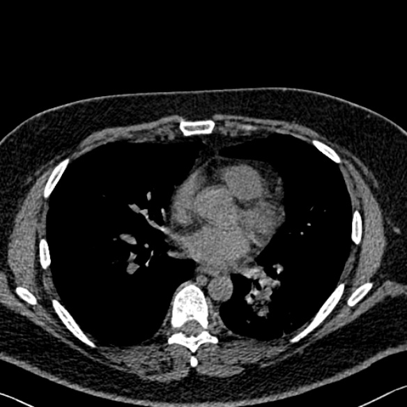 Adenoid cystic carcinoma of the trachea (Radiopaedia 49042-54137 Axial non-contrast 196).jpg