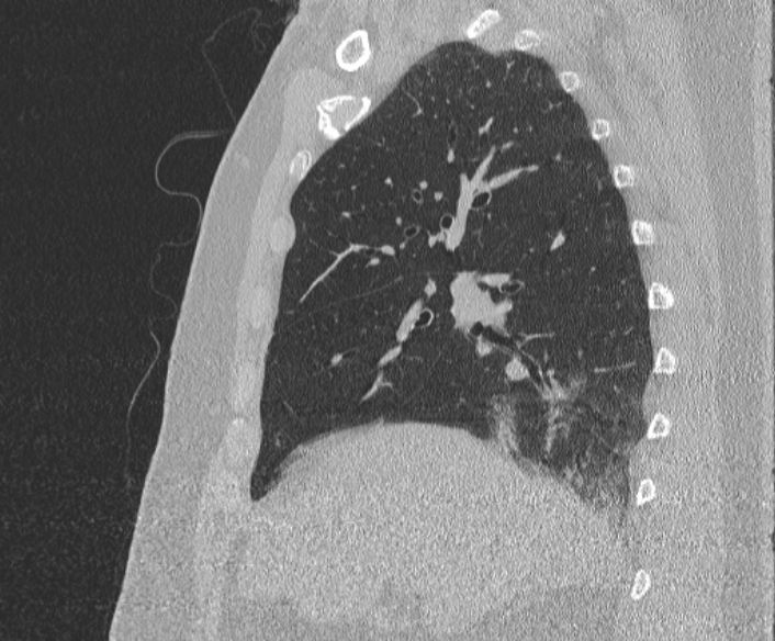 Adenoid cystic carcinoma of the trachea (Radiopaedia 49042-54137 Sagittal lung window 166).jpg