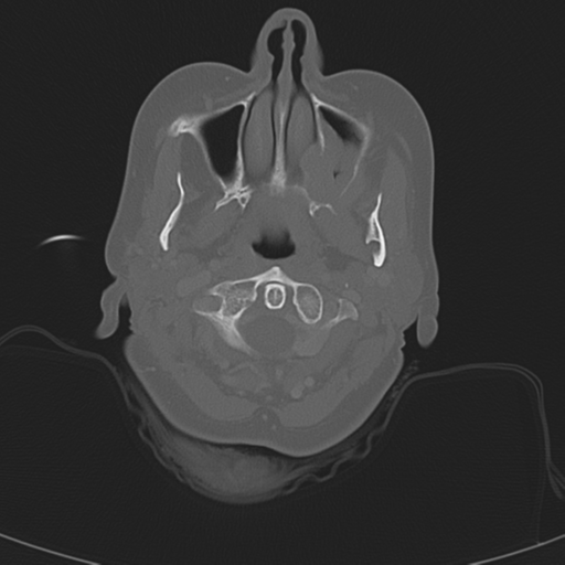 Adenoid cystic tumor of palate (Radiopaedia 46980-51518 Axial bone window 26).png
