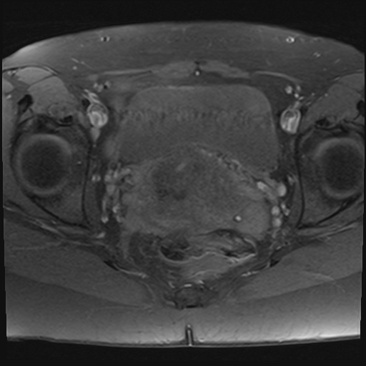 File:Adenomyosis and endometriotic cysts (Radiopaedia 82300-96367 Axial T1 fat sat 8).jpg
