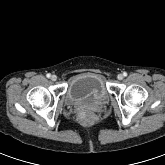 Adhesional small bowel obstruction (Radiopaedia 48397-53305 Axial C+ portal venous phase 91).jpg