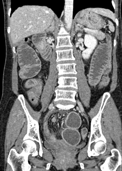 Adhesional small bowel obstruction (Radiopaedia 48397-53305 Coronal C+ portal venous phase 212).jpg