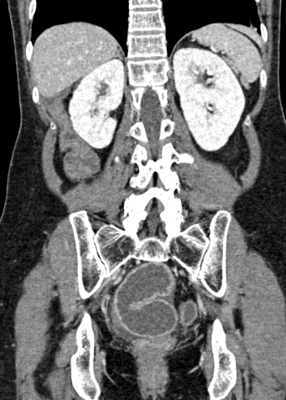Adhesional small bowel obstruction (Radiopaedia 48397-53305 Coronal C+ portal venous phase 254).jpg
