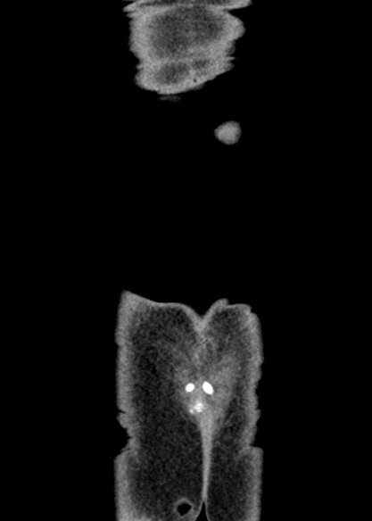 Adhesional small bowel obstruction (Radiopaedia 48397-53305 Coronal C+ portal venous phase 353).jpg