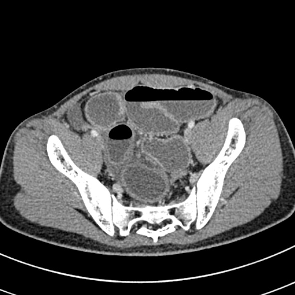 Adhesional small bowel obstruction (Radiopaedia 52107-57980 Axial C+ portal venous phase 104).jpg