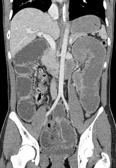 Adhesional small bowel obstruction (Radiopaedia 52107-57980 Coronal C+ portal venous phase 43).jpg