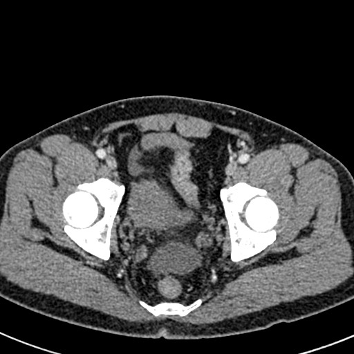 File:Adhesional small bowel obstruction (Radiopaedia 58900-66131 Axial C+ portal venous phase 49).jpg