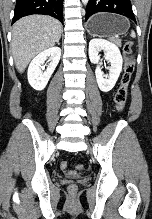 Adhesional small bowel obstruction (Radiopaedia 58900-66131 Coronal C+ portal venous phase 176).jpg