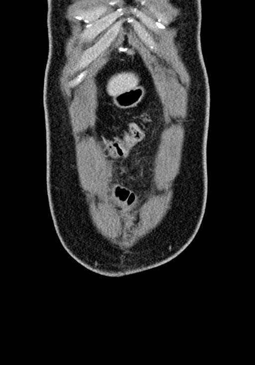 Adhesional small bowel obstruction (Radiopaedia 58900-66131 Coronal C+ portal venous phase 62).jpg