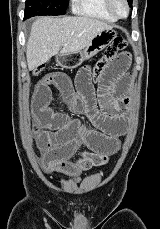 Adhesional small bowel obstruction (Radiopaedia 58900-66131 Coronal C+ portal venous phase 91).jpg
