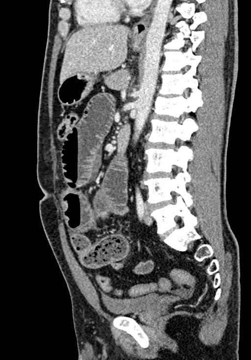 Adhesional small bowel obstruction (Radiopaedia 58900-66131 Sagittal C+ portal venous phase 139).jpg