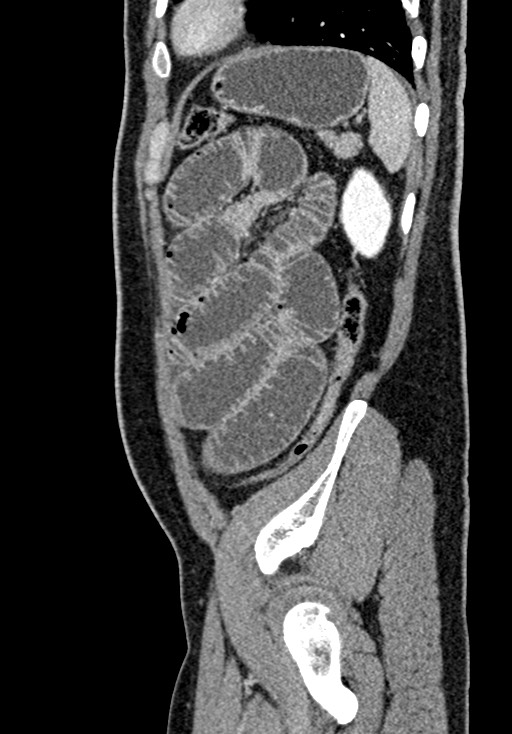 Adhesional small bowel obstruction (Radiopaedia 58900-66131 Sagittal C+ portal venous phase 204).jpg
