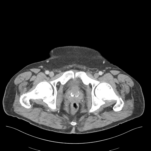 File:Adhesions within abdominal wall hernia (Radiopaedia 58283-65394 Axial C+ portal venous phase 82).png