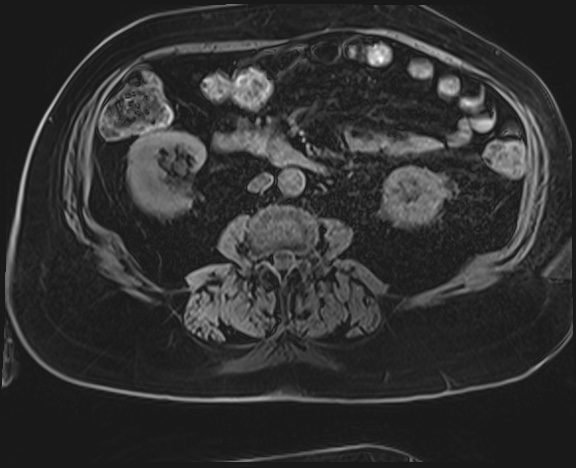 File:Adrenal cortical carcinoma (Radiopaedia 64017-72770 Axial T1 C+ fat sat 35).jpg