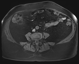 Adrenal cortical carcinoma (Radiopaedia 64017-72770 Axial T1 fat sat 67).jpg