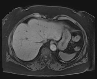 Adrenal cortical carcinoma (Radiopaedia 64017-72770 Axial T1 fat sat 8).jpg